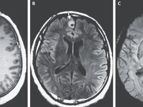 Un ver mort découvert dans le cerveau d’un homme (Photo)